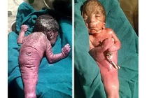 Sốc: “Người cá” vừa được sinh ra tại Ấn Độ