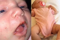 Cháu bé lở loét vì người lớn hôn hít nhiều