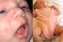 Cháu bé lở loét vì người lớn hôn hít nhiều
