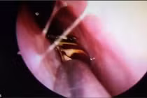 Sốc nặng khi phát hiện gián sống trong sọ người 