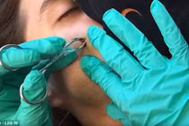 Kinh hãi những pha nặn mụn... “tử thần” suýt “gọi tên” ở Việt Nam