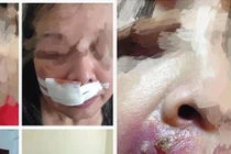 Soi vùng “tam giác tử thần” gây chết người vì nặn mụn