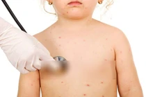 Sai lầm chết người từ việc tắm lá trị bệnh thủy đậu