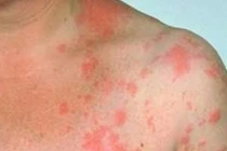 Những loại ung thư nguy hiểm với nam giới