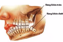 “Răng khôn mọc dại” và những biến chứng chết người 