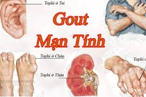 Kinh hoàng hình ảnh bệnh gout tàn phá cơ thể