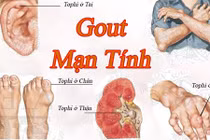 Kinh hoàng hình ảnh bệnh gout tàn phá cơ thể