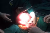 Mổ lấy khối u tử cung 12kg cho người đàn bà 53 tuổi 