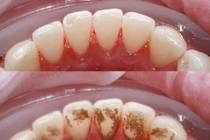 Cả đời không cần đi lấy cao răng nếu súc miệng nước này