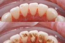 Cả đời không cần đi lấy cao răng nếu súc miệng nước này