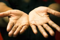 Nốt ruồi bần hàn mọc ở đâu trên bàn tay bạn? 