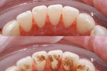 Loại nước ngậm vào cao răng biến mất chỉ sau 1 phút