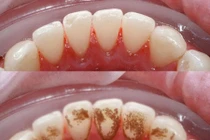 Loại nước ngậm vào cao răng biến mất chỉ sau 1 phút