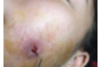 Kinh hoàng trào lưu má lúm đồng tiền khiến khuôn mặt bị hủy hoại