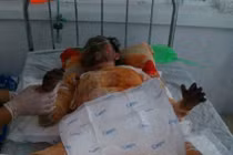 Xót thương cô gái xinh đẹp bị bỏng cấp độ 5 do xăng bất ngờ cháy