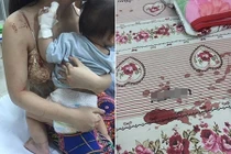 Mẹ sốc vì con bị chuột cắn nát tay khi đang ngủ