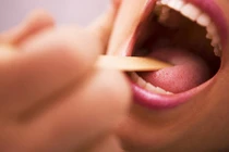 Đi khám ngay nếu có dấu hiệu ung thư vòm họng này 