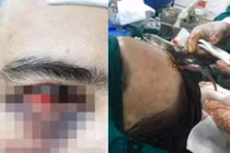 Hotboy bị tụ huyết sưng phù mắt vì phẫu thuật thẩm mỹ rởm 