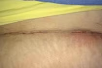 Hy hữu: Sản phụ đau đẻ 36 tiếng, mổ bụng không thấy con