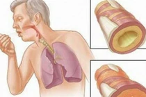 Biểu hiện lạ nguy hiểm trong chữa ung thư phổi
