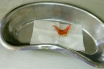 Hy hữu, răng giả rơi xuống ruột già, đâm thủng đại tràng