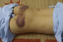 Cháu bé 12 tuổi nhập viện vì bị mẹ kế đánh