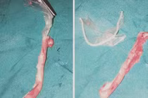 Khiếp vía phát hiện bao cao su trong ruột thừa của nữ bệnh nhân