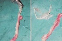 Khiếp vía phát hiện bao cao su trong ruột thừa của nữ bệnh nhân