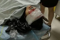 Sống sót thần kì dù bị kìm đâm xuyên não 15 cm