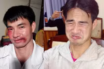 Xuân Bắc bị đánh bầm mặt