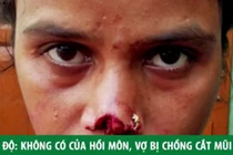 Chồng cắt mũi vợ vì không có của hồi môn