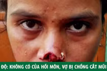 Chồng cắt mũi vợ vì không có của hồi môn