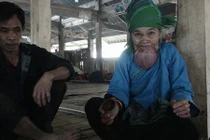 Xót xa cụ bà ở Hà Giang khổ sở vì lưỡi khổng lồ