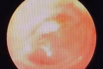 Vá lỗ thủng màng nhĩ rộng bằng… giấy