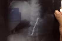 Bé 2 tuổi nhập viện khi nuốt 13 viên bi nam châm