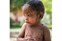 Bé gái 2 tuổi mắc bệnh lạ, da mọc vẩy như thằn lằn