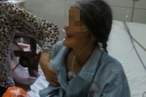 Choáng váng khi bóc lớp da bị chai dưới gót chân bị hoại tử 