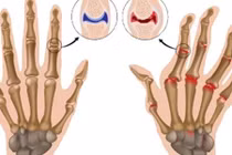 Bí mật của tiếng kêu răng rắc xuất hiện khi bẻ đốt ngón tay