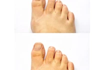 Lạnh bàn chân - dấu hiệu bệnh tim mạch