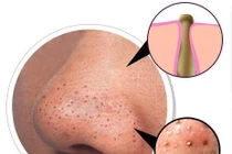 Bí kíp lột mụn đầu đen đúng cách giúp se khít lỗ chân 