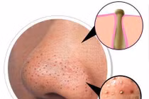 Bí kíp lột mụn đầu đen đúng cách giúp se khít lỗ chân 