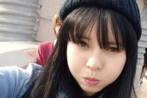 Kinh ngạc cô gái sứt môi “vịt hóa thiên nga” nhờ dao kéo