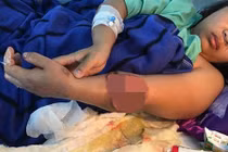 Cô gái 21 tuổi hồi sinh cánh tay kỳ diệu
