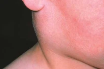 Tại sao quai bị có thể gây vô sinh?