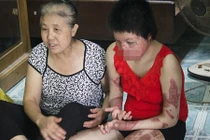 Người bị chồng tưới xăng đốt: "Con thấy mặt tôi là khóc thét"