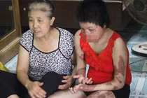 Người bị chồng tưới xăng đốt: "Con thấy mặt tôi là khóc thét"