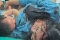 Xúc động cảnh mẹ gẫy chân tay vẫn cố cho con bú