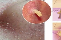 Mụn đầu đen ở mũi tự khắc chui ra nhờ hỗn hợp này 