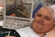 Chỉ vì 1 sợi lông mọc ngược, mang khối u 63 kg 