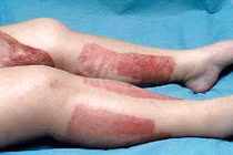 Hôn mê, chân hoại tử vì cạo lông vùng kín